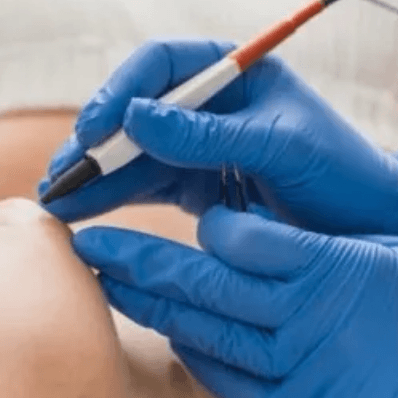 30 min Electrolysis Package at Skin Couture in Chicago, IL