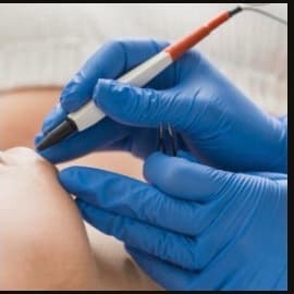 Electrolysis Package at Skin Couture in Chicago, IL